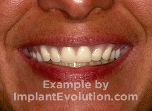 procedure after image All on 4 procedure after image All on 4