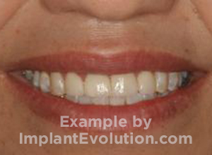 procedure after image Cemented Crowns procedure after image Cemented Crowns