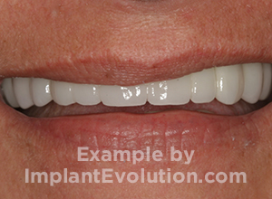procedure after image Dental Bridges procedure after image Dental Bridges
