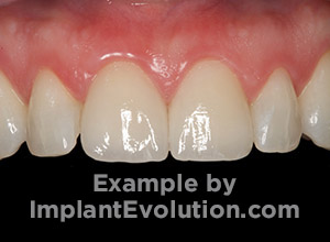 procedure after image Dental Crowns procedure after image Dental Crowns