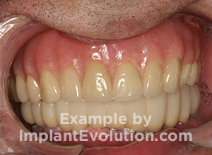 procedure after image Dentures procedure after image Dentures