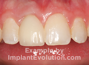 procedure after image Front Tooth Implant procedure after image Front Tooth Implant