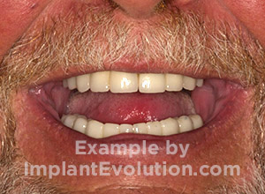 procedure after image Full Mouth Implants procedure after image Full Mouth Implants