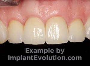procedure after image Implant Cosmetics procedure after image Implant Cosmetics
