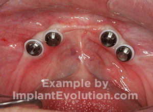 procedure after image Locator Overdentures procedure after image Locator Overdentures
