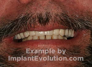 procedure after image Overdentures procedure after image Overdentures