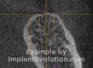 procedure after image Ridge Augmentation procedure after image Ridge Augmentation