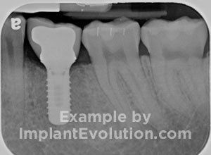 procedure after image Single Posterior Implant procedure after image Single Posterior Implant