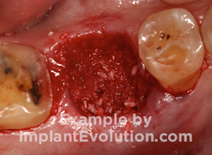 procedure after image Socket Preservation procedure after image Socket Preservation