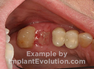 procedure after image Tooth Extractions procedure after image Tooth Extractions