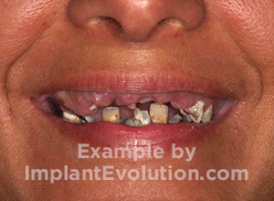 procedure before image All on 4 procedure before image All on 4