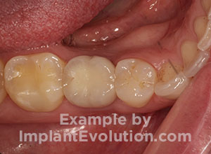 procedure before image Cemented Crowns procedure before image Cemented Crowns