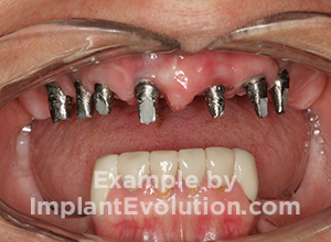 procedure before image Dental Bridges procedure before image Dental Bridges