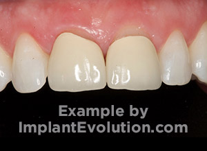 procedure before image Dental Crowns procedure before image Dental Crowns