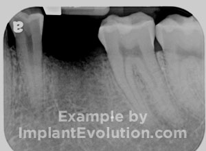 procedure before image Dental Implants procedure before image Dental Implants