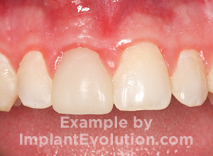 procedure before image Front Tooth Implant procedure before image Front Tooth Implant