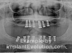 procedure before image Full Mouth Implants procedure before image Full Mouth Implants