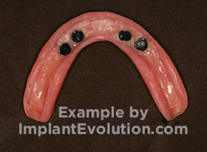 procedure before image Locator Overdentures procedure before image Locator Overdentures
