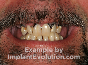 procedure before image Overdentures procedure before image Overdentures