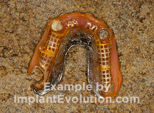 procedure before image Partial Dentures procedure before image Partial Dentures