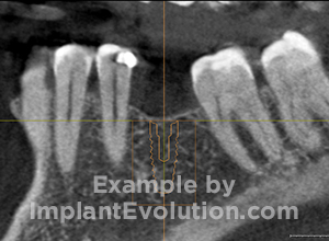 procedure before image Ridge Augmentation procedure before image Ridge Augmentation