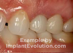 procedure before image Screw Retained Crowns procedure before image Screw Retained Crowns