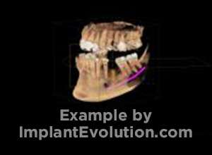 procedure before image Single Posterior Implant procedure before image Single Posterior Implant