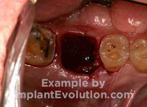 procedure before image Socket Preservation procedure before image Socket Preservation